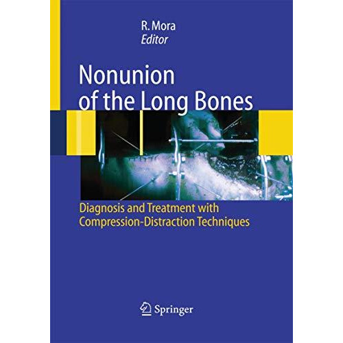 Nonunion of the Long Bones: Diagnosis and treatment with compression-distraction [Paperback]