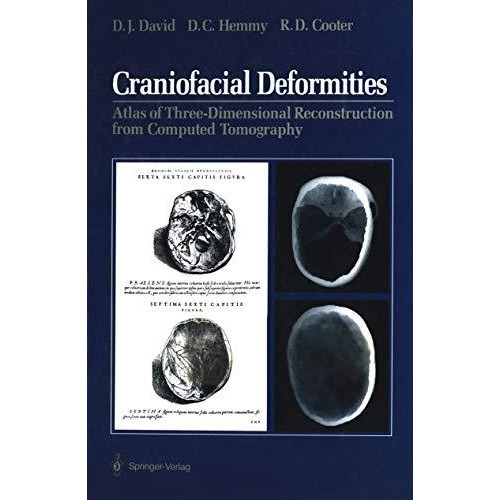 Craniofacial Deformities: Atlas of Three-Dimensional Reconstruction from Compute [Paperback]