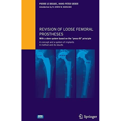 Revision of loose femoral prostheses with a stem system based on the  press-fit  [Mixed media product]