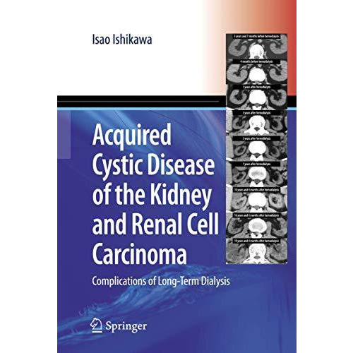 Acquired Cystic Disease of the Kidney and Renal Cell Carcinoma: Complication of  [Hardcover]