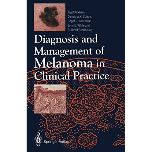 Diagnosis and Management of Melanoma in Clinical Practice [Paperback]