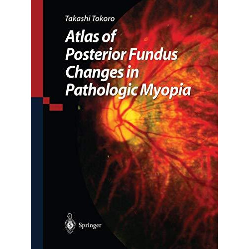 Atlas of Posterior Fundus Changes in Pathologic Myopia [Paperback]