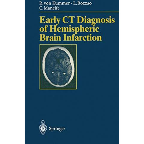 Early CT Diagnosis of Hemispheric Brain Infarction [Paperback]