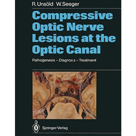 Compressive Optic Nerve Lesions at the Optic Canal: Pathogenesis  Diagnosis  T [Paperback]