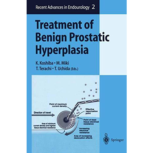 Treatment of Benign Prostatic Hyperplasia [Paperback]